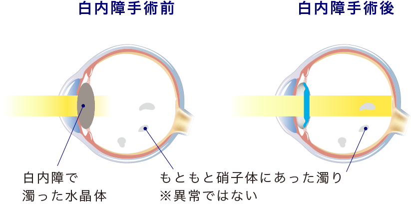 イメージ：飛蚊症・硝子体混濁