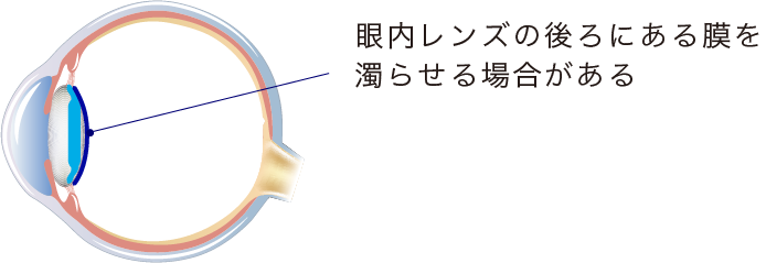 イメージ：後発白内障